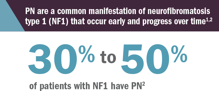 Plexiform Neurofibroma Prevalence – 30% to 50% of Patients with NF1 have PN